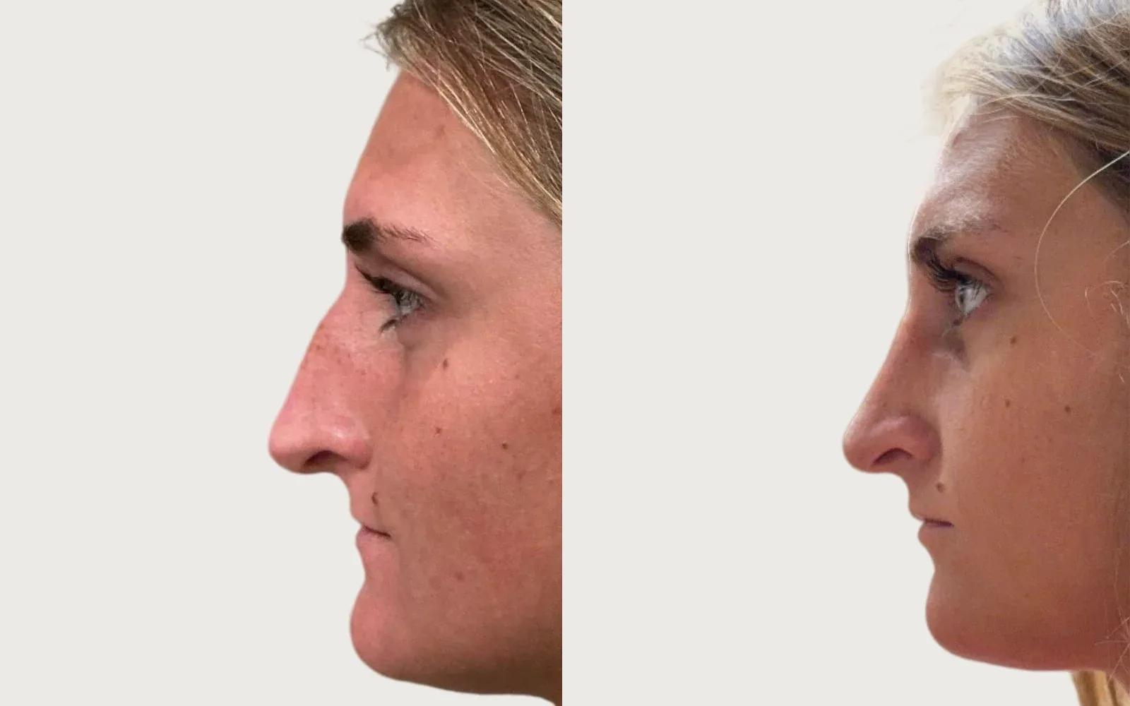 Rhinoplasty before and after, patient 1, Holy City Plastic Surgery, Charleston SC