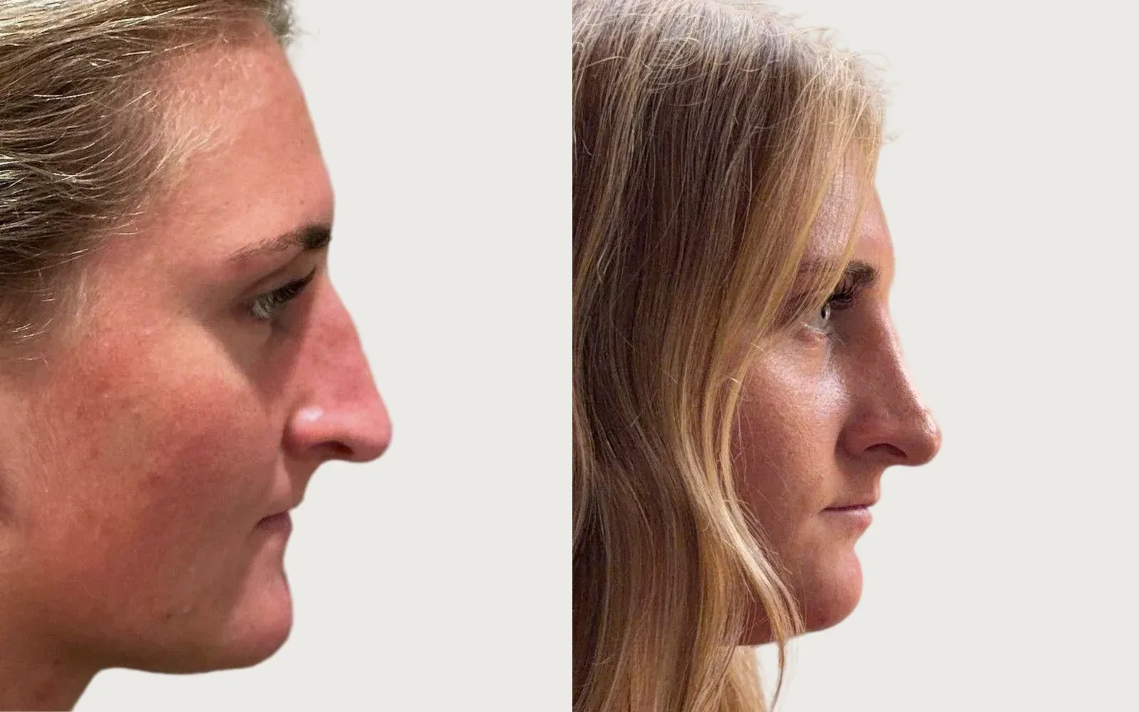 Rhinoplasty before and after, patient 1, Holy City Plastic Surgery, Charleston SC