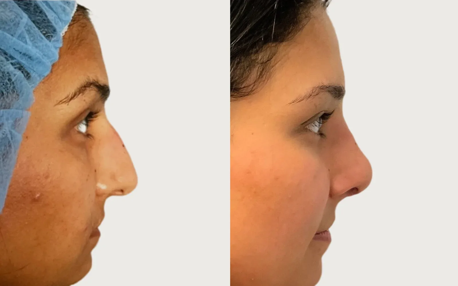 Rhinoplasty before and after, patient 2, Holy City Plastic Surgery, Charleston SC