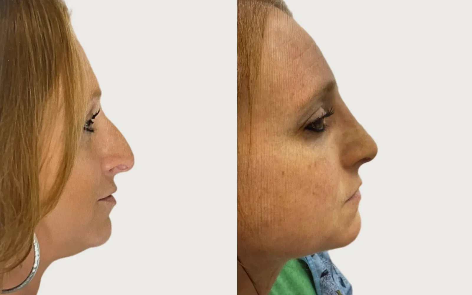 Rhinoplasty before and after, patient 3, Holy City Plastic Surgery, Charleston SC