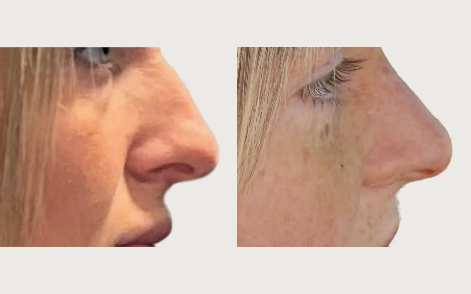 Rhinoplasty before and after, patient 4, Holy City Plastic Surgery, Charleston SC