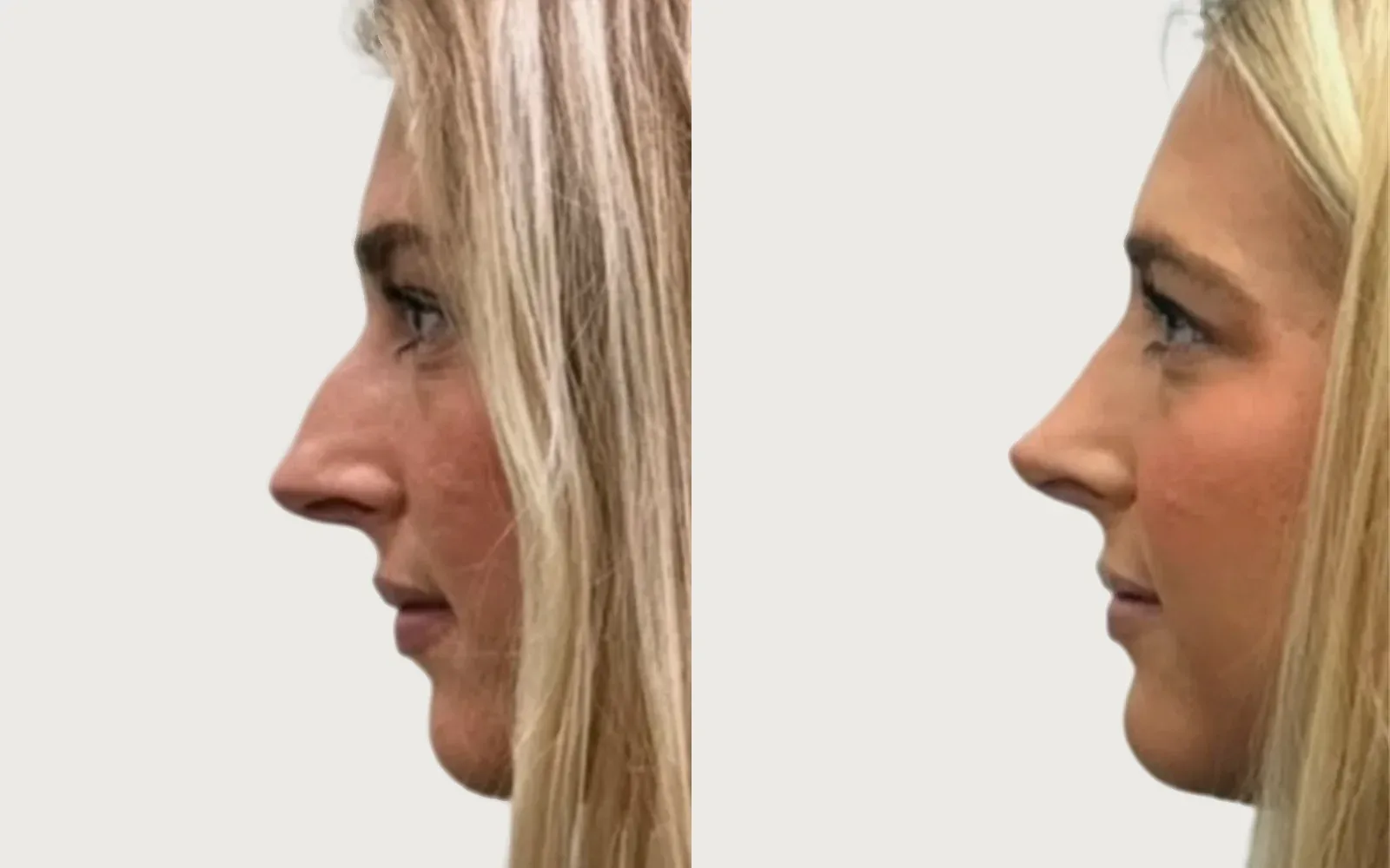 Rhinoplasty before and after, patient 5, Holy City Plastic Surgery, Charleston SC