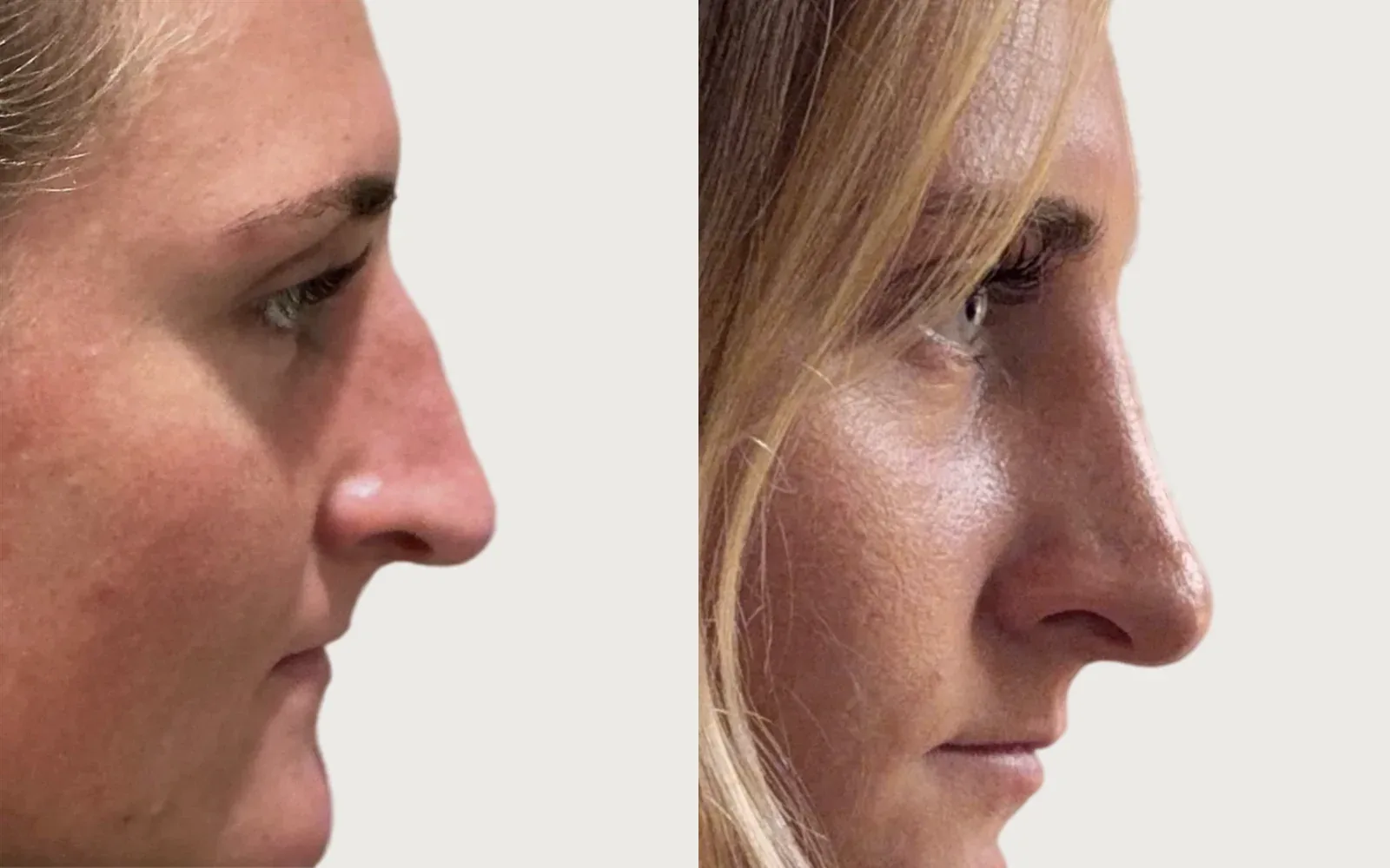 Rhinoplasty before and after, patient 6, Holy City Plastic Surgery, Charleston SC