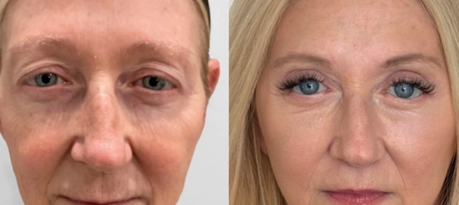 Natural brow and eyelid result after surgery
