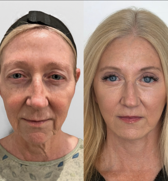 Refreshed, rested eyes after eyelid surgery