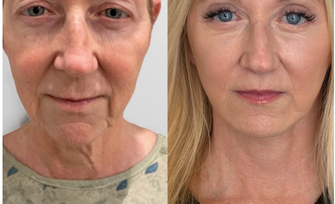 Facelift and neck lift before and after, front view